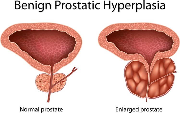prostata 2